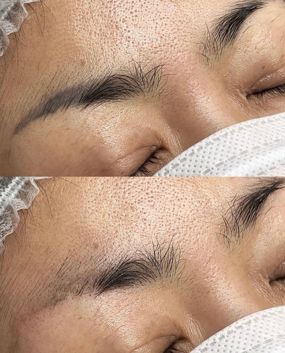 Old brow tattoo before laser removal (top) and lightened after removal (bottom), by The Line Brows